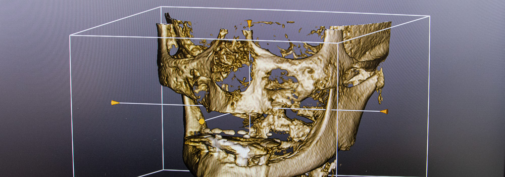 gasser zahntechnik: Implantate planen